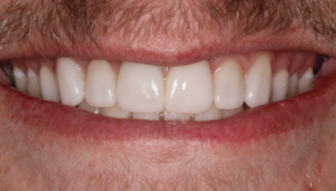 Smile Makeover Case 25 - After