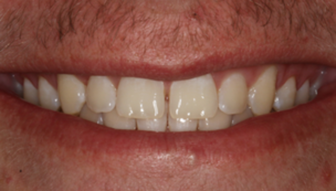 Smile Makeover Case 25 - Before
