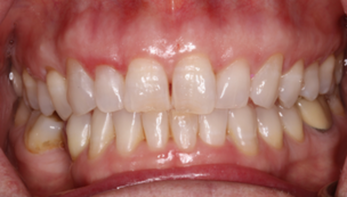 Smile Makeover Case 26 - Before