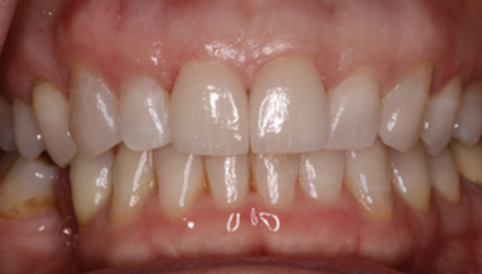 Smile Makeover Case 26 - After