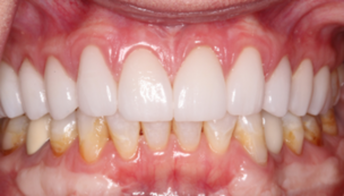 Smile Makeover Case 27 - After