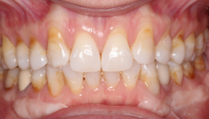 Smile Makeover Case 27 - Before