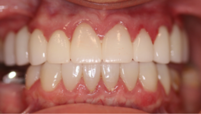 Full Mouth Reconstruction Case 5 - After
