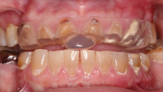Full Mouth Reconstruction Case 5 - Before