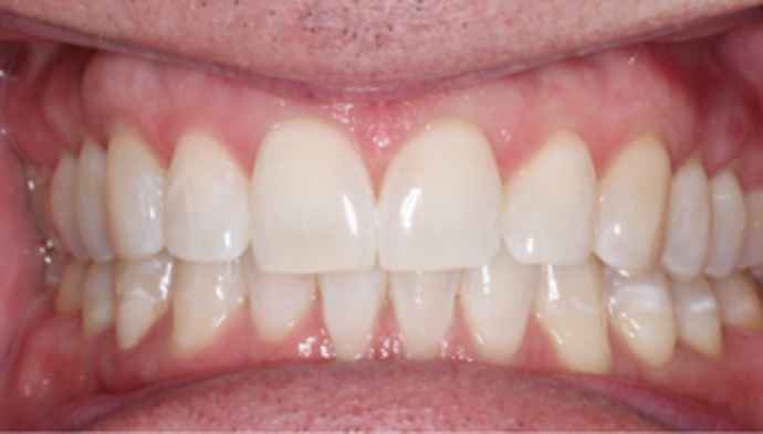 Teeth Whitening Case 1 - After