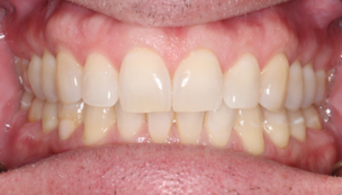 Teeth Whitening Case 1 - Before