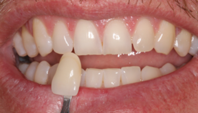 Teeth Whitening Case 2 - Before
