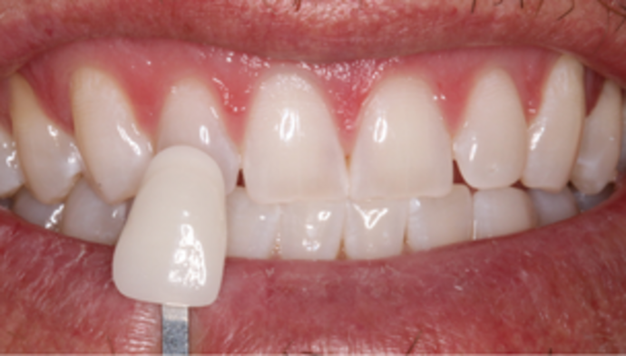 Teeth Whitening Case 2 - After