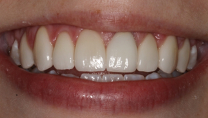 Veneers Case 11 - After