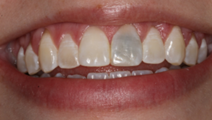 Veneers Case 11 - Before