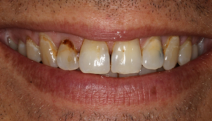 Veneers Case 12 - Before