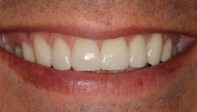 Veneers Case 12 - After