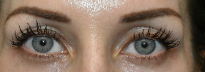 Eye Lift (Blepharoplasty) Case 1 - Before