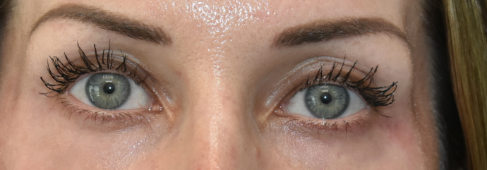 Eye Lift (Blepharoplasty) Case 1 - After