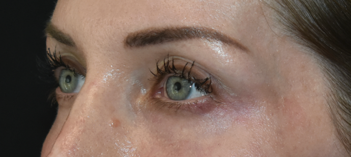 Eye Lift (Blepharoplasty): Case 1 - After