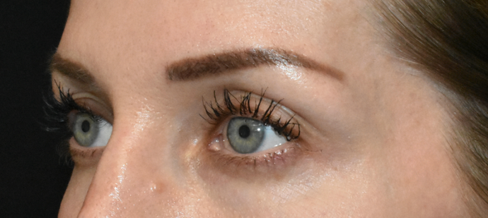 Eye Lift (Blepharoplasty): Case 1 - Before