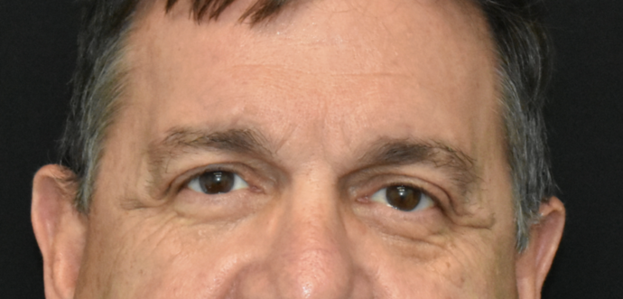Eye Lift (Blepharoplasty) Case 2 - Before
