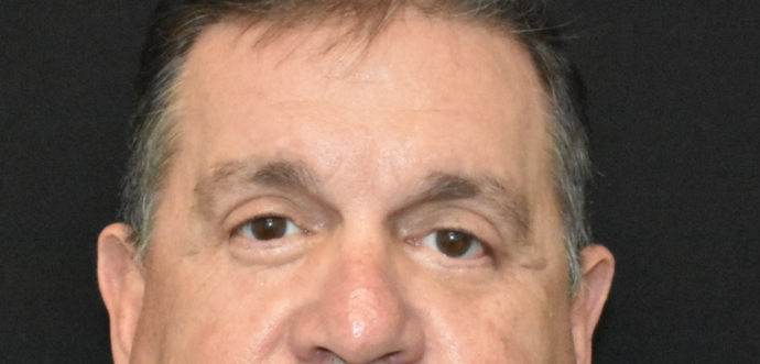 Eye Lift (Blepharoplasty) Case 2 - After