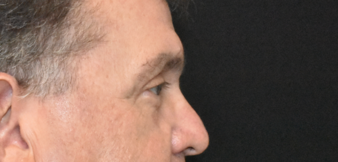 Eye Lift (Blepharoplasty): Case 2 - After