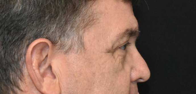 Eye Lift (Blepharoplasty): Case 2 - Before
