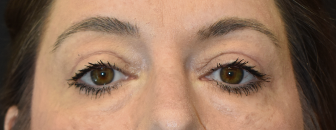 Eye Lift (Blepharoplasty) Case 3 - After