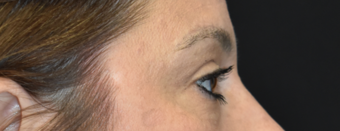 Eye Lift (Blepharoplasty): Case 3 - After
