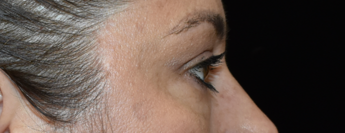 Eye Lift (Blepharoplasty): Case 3 - Before