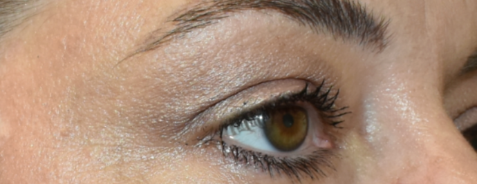 Eye Lift (Blepharoplasty): Case 3 - Before