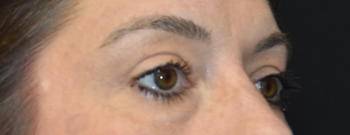 Eye Lift (Blepharoplasty): Case 3 - After