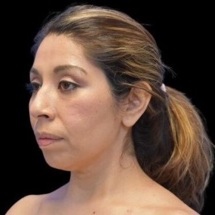 Facial Rejuvenation: FaceTite - Before