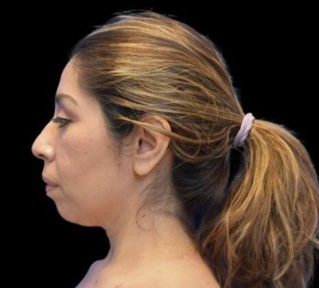 Facial Rejuvenation FaceTite - Before