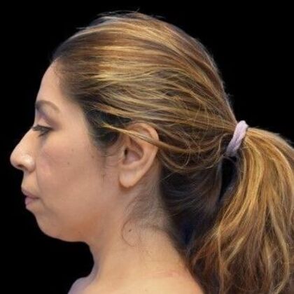 Facial Rejuvenation FaceTite - Before