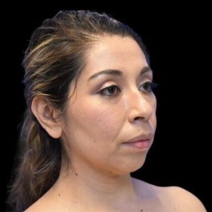 Facial Rejuvenation: FaceTite - Before