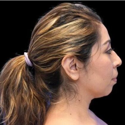 Facial Rejuvenation: FaceTite - Before