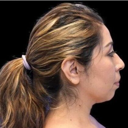 Facial Rejuvenation: FaceTite - Before