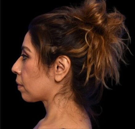 Facial Rejuvenation FaceTite - After