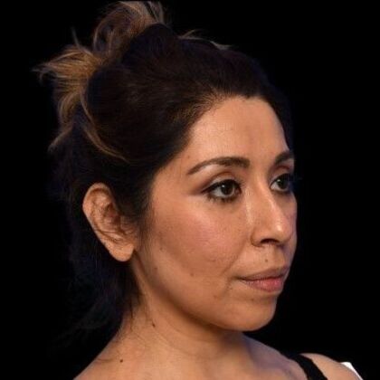 Facial Rejuvenation: FaceTite - After