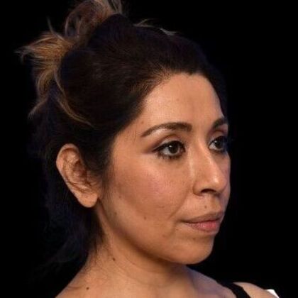 Facial Rejuvenation: FaceTite - After