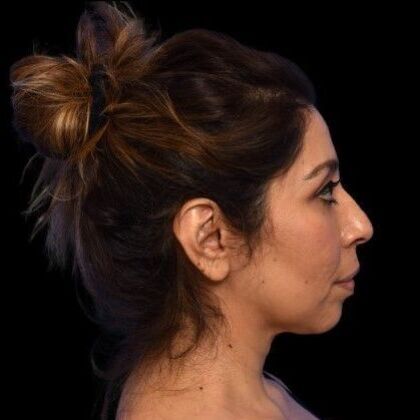 Facial Rejuvenation: FaceTite - After