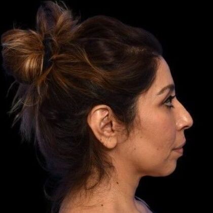 Facial Rejuvenation: FaceTite - After