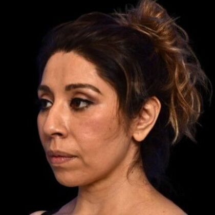 Facial Rejuvenation: FaceTite - After