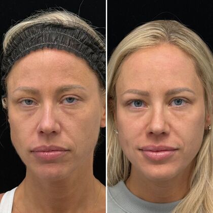 HALO Laser Skin Resurfacing Case 1