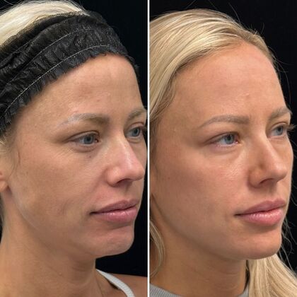 HALO Laser Skin Resurfacing: Case 1 - Right Profile - Before and After