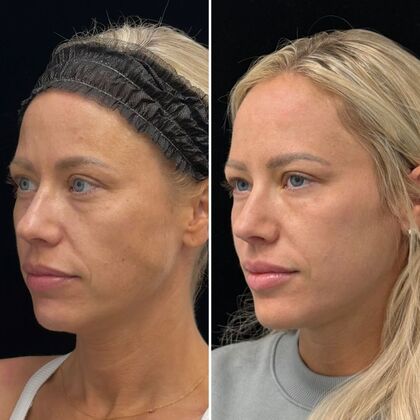 HALO Laser Skin Resurfacing: Case 1 - Left Profile - Before and After