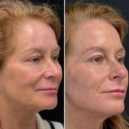 HALO Laser Skin Resurfacing: Case 2 - Profile - Before and After