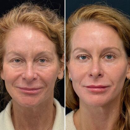HALO Laser Skin Resurfacing Case 2