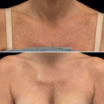 HALO Laser Skin Resurfacing Case 3