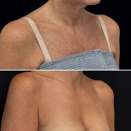 HALO Laser Skin Resurfacing: Case 3 - Right Profile - Before and After