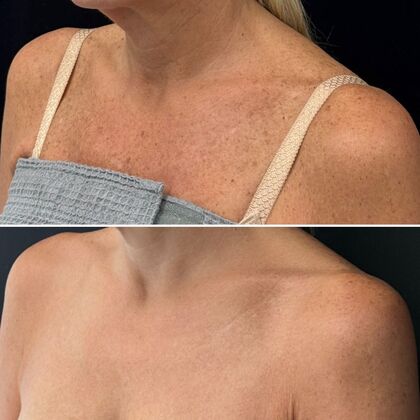 HALO Laser Skin Resurfacing: Case 3 - Left Profile - Before and After