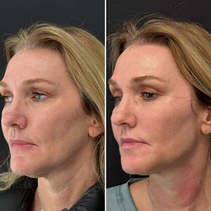 TRL Laser Skin Resurfacing: Case 1 - Left Profile - Before and After